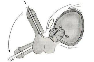 Esquema de cirurgia endoscópica de aumento do pênis