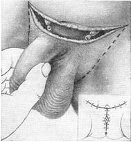 Alongamento cirúrgico do pênis, retirando sua parte oculta