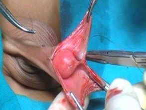 Cirurgia de aumento do pênis masculino