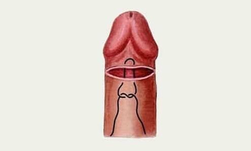 glande do pênis